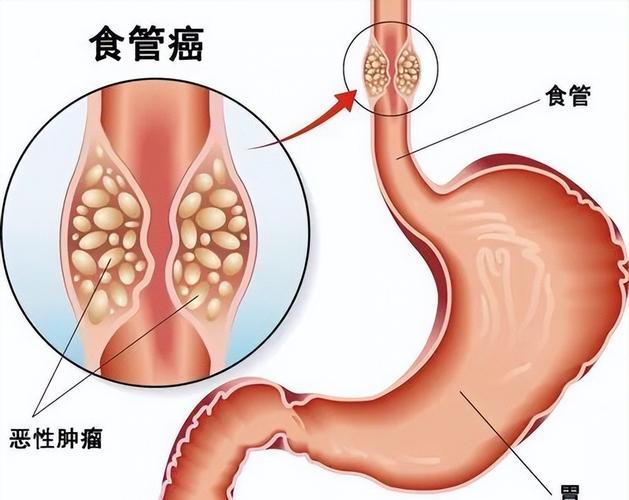 全球一半食管癌都在中国，我们到底吃错了什么，沈丘水果种植基地在哪里。 全球一半食管癌都在中国，我们到底吃错了什么，沈丘水果种植基地在哪里。 畜牧养殖